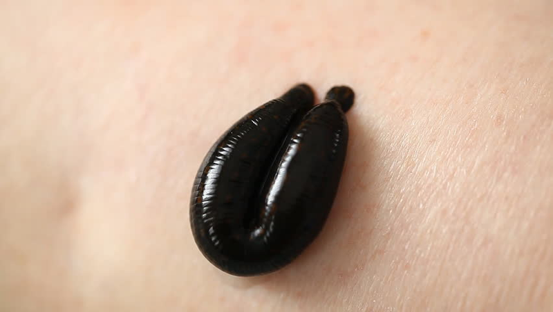 Illustration for article titled Best Leech Therapy Treatment In India